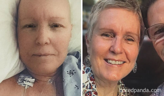 Победили рак сами. Люди до и после химиотерапии. Раковые больные до и после. Люди с онкологией до и после. Люди после химиотерапии до и после.